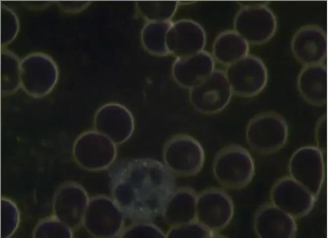 Erytrocyty czerwone krwinki przed wypiciem zdrowej WODY STARLIFE 11.02.