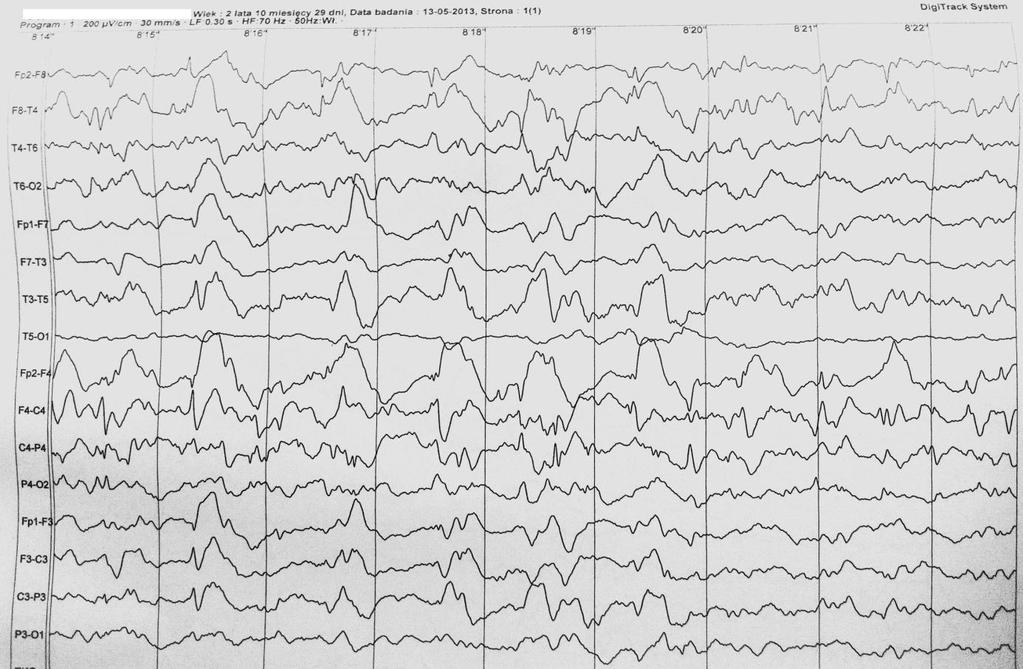 Przez kolejne półtora roku u chłopca, pomimo leczenia farmakologicznego, codziennie występowały napady padaczkowe: częściowe proste dotyczące lewej połowy ciała, czasem wtórnie uogólnione oraz