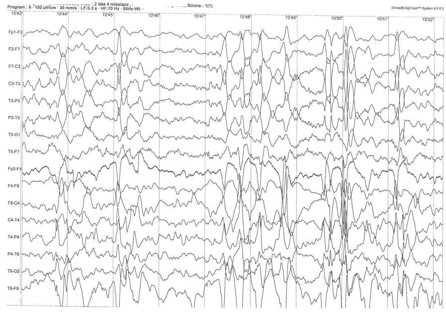 RYCINA 9. BADANIE EEG PACJENTA Z HETEROTOPIĄ NEURONALNĄ WYKONANE W WIEKU 2 LAT 4 MIESIĘCY Widoczne są uogólnione wysokonapięciowe zespoły iglica-fala.
