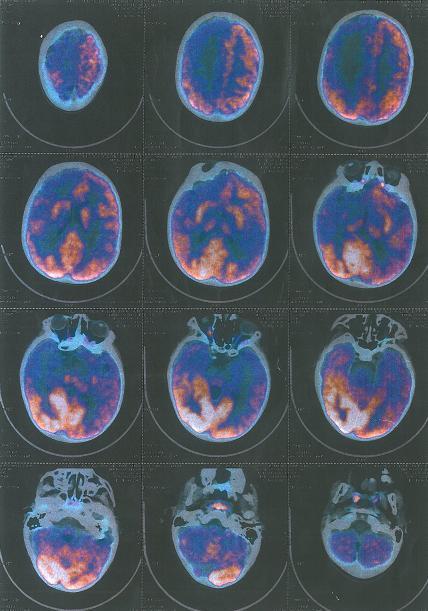 RYCINA 10. BADANIE PET PACJENTA Z HETEROTOPIĄ W OBRĘBIE PRAWEGO PŁATA CZOŁOWEGO Uwidoczniono ognisko padaczkorodne w płatach potylicznych (aktywny metabolicznie obszar badanie iktalne).