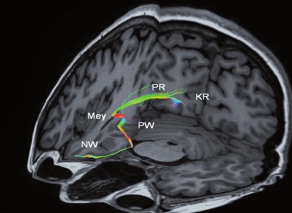 Polski Przegląd Neurologiczny, 2015, tom 11, nr 2 Rycina 2.