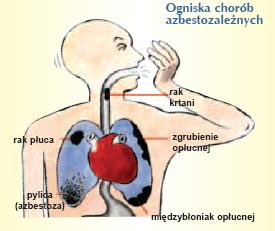 4.3. Zdrowotne skutki obecności azbestu w środowisku człowieka Chorobotwórcze działanie azbestu jest wynikiem wdychania włókien zawieszonych w powietrzu.