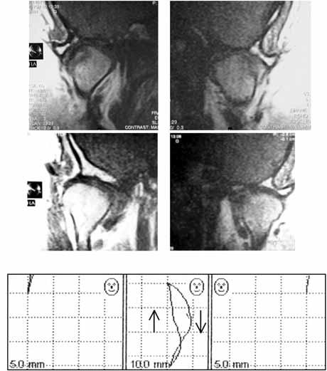 In the left TMJ a partial medial disc displacement is visible Ryc. 5.