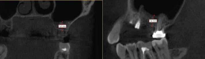 _materiały augmentacyjne Ryc. 3 Ryc. 4 Ryc. 3 i 4_CBCT po podniesieniu zatoki kwasem hialuronowym z GBR.