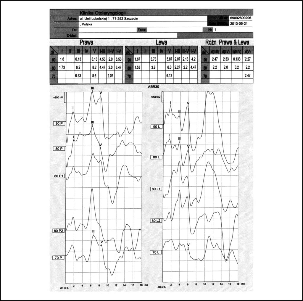 polski przegląd otorynolaryngologiczny 2 (2013) 189 193 [(Ryc._1)TD$FIG] 191 Ryc. 1 Wynik badania ABR: wydłużony intewał I III po stronie prawej (pacjent Z.T.) Fig.