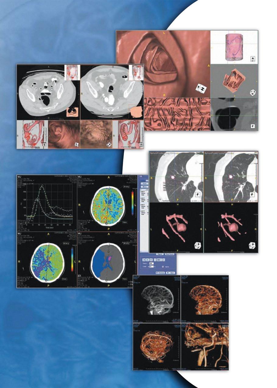 Wirtualna endoskopia Równoczesny przegląd dwóch serii obrazów okrężnicy Analiza i śledzenie segmentacji