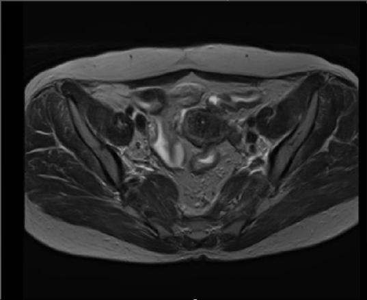 frakcja CT (skany co 3mm )+MR,rekonstrukcja na CT, fuzja z MR