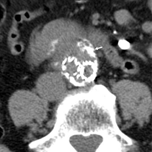 Znaczenie badań obrazowych w monitorowaniu chorych po wewnątrznaczyniowym leczeniu tętniaków aorty brzusznej W przeprowadzonym badaniu angio-tk przed podaniem i po podaniu środka cieniującego u