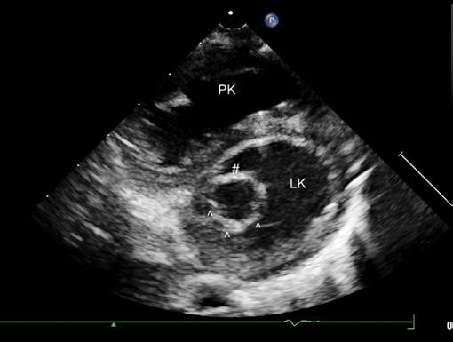 Widoczny podaortalny ubytek w przegrodzie międzykomorowej z turbulentnym przeciekiem lewo- -prawym. Zaznaczona dekstropozycja aorty.