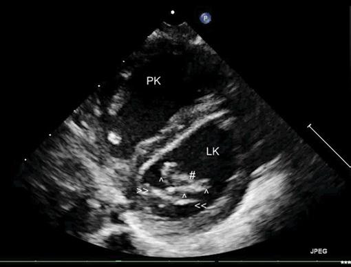 6: wiązka ultradźwięków przemieszczona nieco ku górze i do przodu. W tym przekroju nie jest już widoczny związek patologicznej błony z aortalnym płatkiem mitralnym. Oznaczenia jak na ryc. 6 Ryc. 8.