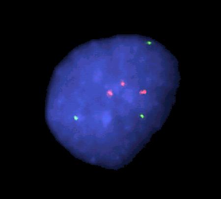 Zastosowanie FISH Zespoły mikrodelecji metoda z wyboru Aberracje struktury chromosomów trudne do identyfikacji metodami klasycznej cytogenetyki Identyfikacja pochodzenia chromosomów markerowych