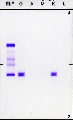 Ryc. 3 Wynik immunofiksacji surowicy, w której wykryto obecność białka monoklonalnego IgG, kappa.