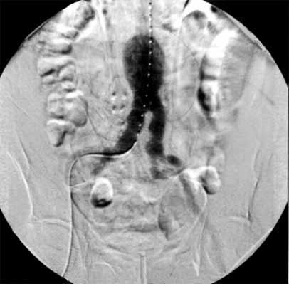 Arteriogram obrazujący tętniak aorty brzusznej w jej podnerkowym odcinku firmed the presence of aneurysm in the subrenal section of the abdominal aorta as well as aneurysms of the initial sections of