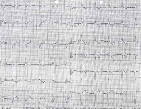 W badaniu elektrokardiograficznym (EKG) po zabiegu zwracały uwagę piki stymulacji przedsionkowej, bez załamków P, i