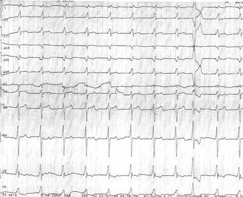 Folia Cardiologica 2015, tom 10, supl. C Omówienie Rycina 4. stymulacji i chorego wypisano do domu z zaleceniem opieki w poradni kardiomiopatii.