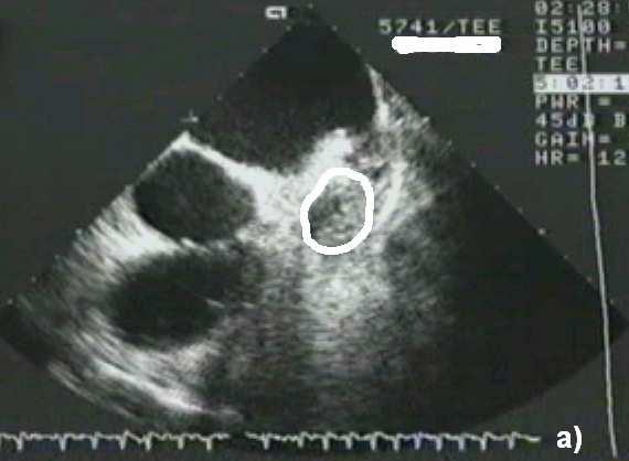 Texture classification Heart