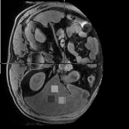 Texture classification Liver diseases (3D MR images) 3D co-occurrence