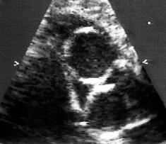 Folia Cardiol. 2001, tom 8, supl. C Wady wrodzone serca (CHD, congenital heart disease) z systemową prawą komorą 1. Przełożenie wielkich pni tętniczych (TGA). 2. Przerwanie ciągłości łuku aorty (IAA).