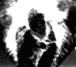 Typy zaburzeń hemodynamicznych w CHD z systemową prawą komorą Typ I zaburzeń: Klinicznym modelowym przykładem jest TGA, gdzie komora anatomicznie prawa jest połączona z aortą i pozostaje po urodzeniu