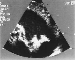 Ciągłość: systemowa prawa komora (RV) tętnica płucna () przetrwały przewód tętniczy (PDA) aorta zstępująca (DAo) wsteczny napływ do naczyń wieńcowych.