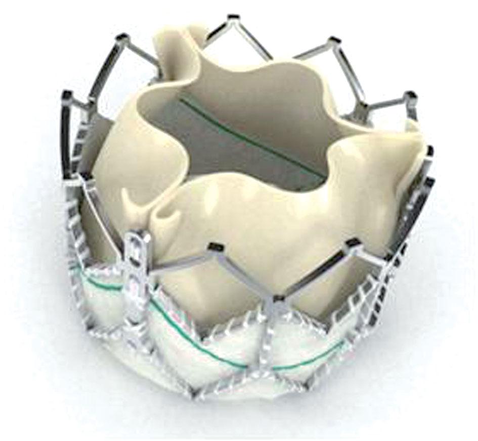 Ryc. 1. Zastawka Sapien XT. Zastawka jest wykonana z osierdzia wołowego i przymocowana do rozprężanego balonem stentu kobaltowo-chromowego Fig. 1. The Sapien XT valve.