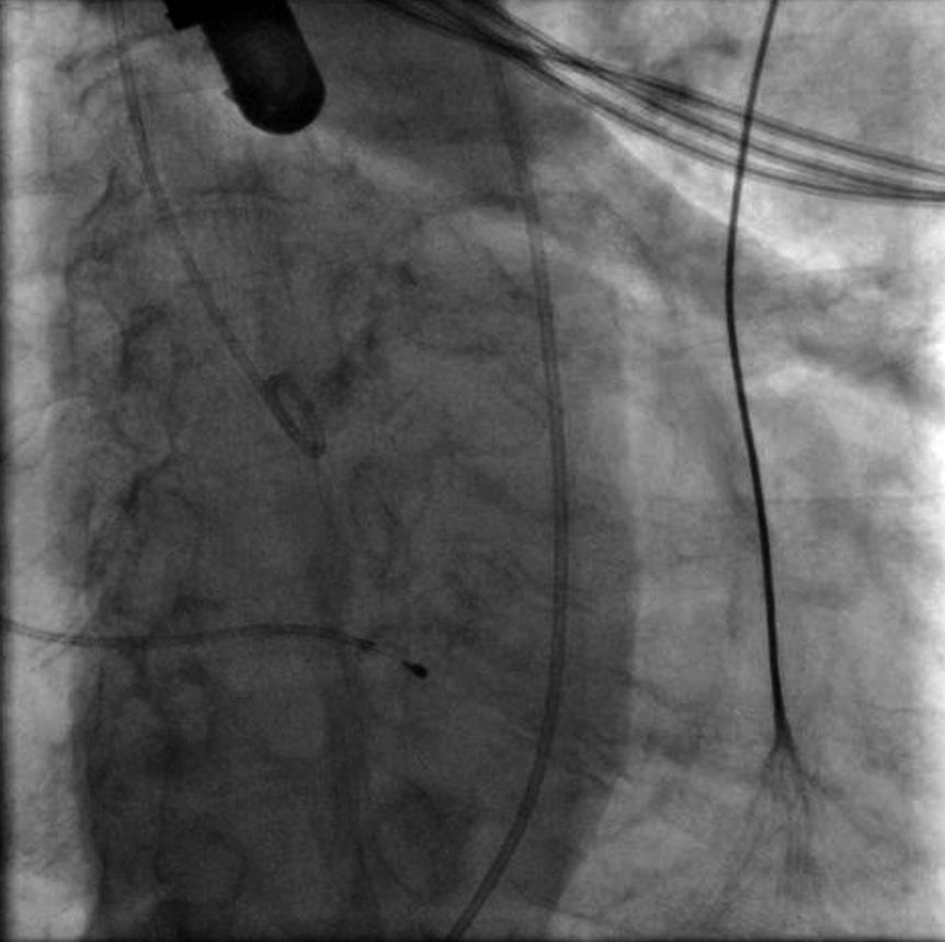Kolejne etapy przezcewnikowej implantacji zastawki aortalnej Projekcja angiograficzna powinna zostać dobrana w ten sposób, żeby wszystkie trzy zatoki aortalne były widoczne w jednej płaszczyźnie, a