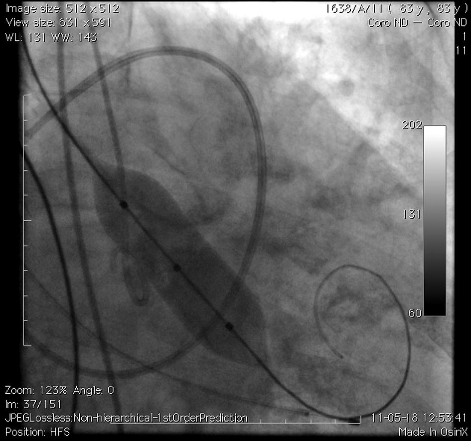 W pierwszym etapie zabiegu TAVI należy wykonać walwuloplastykę balonową natywnej zastawki aortalnej w celu utorowania drogi dla sztucznej zastawki i jest to jedno z nielicznych już obecnie wskazań