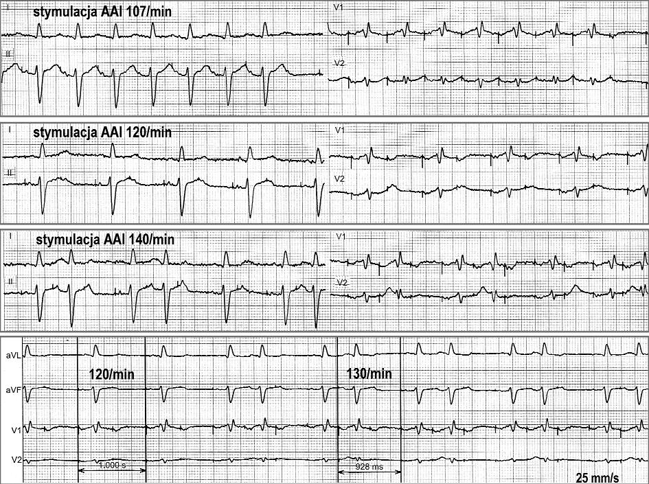 Supernormalna pobudliwość i przewodzenie w sercu człowieka elektrokardiograficzny mit czy rzeczywistość? 1033 Rycina 3.