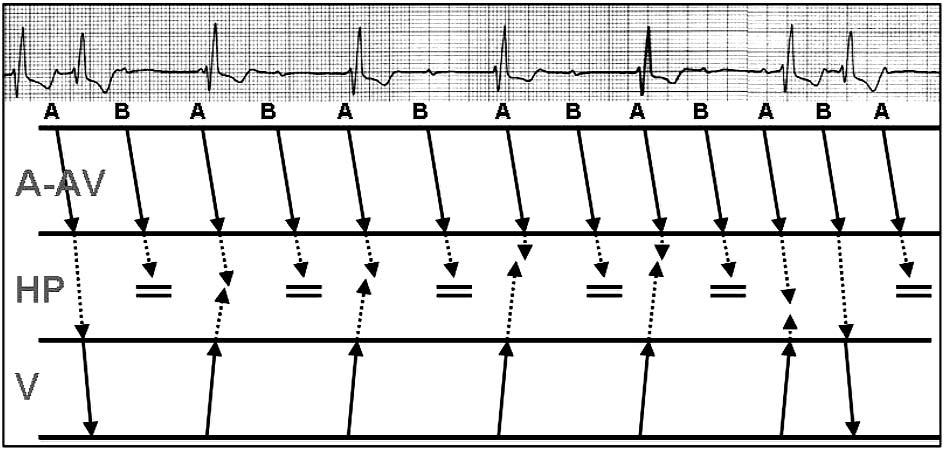 1034 Marek Jastrzębski Rycina 4. Diagram Lewisa obrazujący blok przedsionkowo-komorowy 2 : 1 z nakładaniem się rytmu idiowentrykularnego.