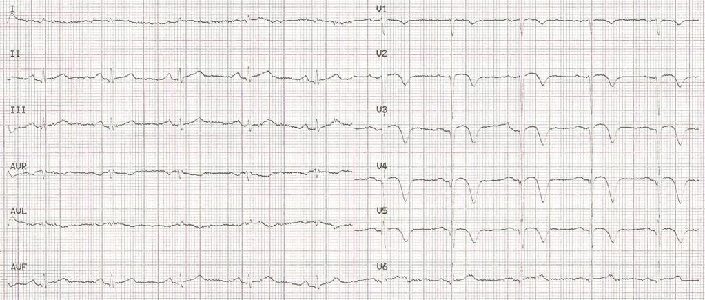 Rycina 1C. EKG 6 tygodni po zawale.