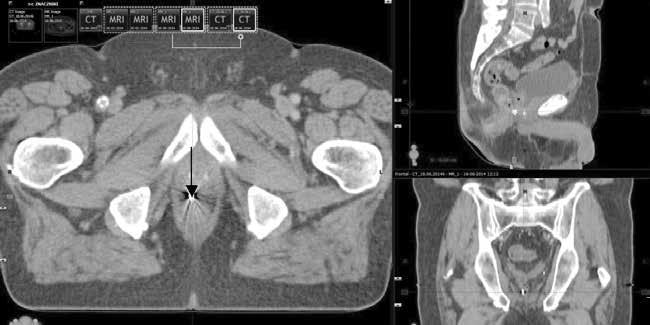 Obrazy tomografii komputerowej ze znacznikami służące do planowania radioterapii. Strzałka wskazuje zwapnienia w prostacie Rycina 5.