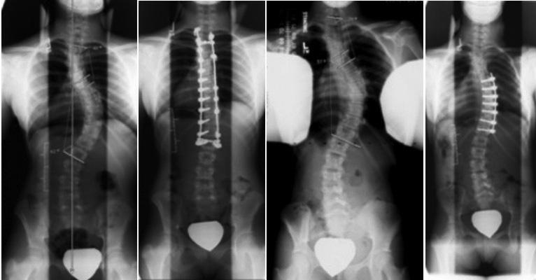 Ryc. 16. Wertebroplastyka dwupoziomowa. Złamania osteoporotyczne Ryc. 17.