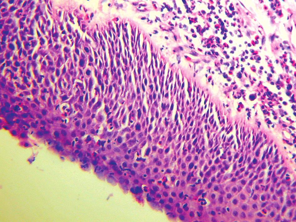 Wycinek z błony śluzowej oskrzela pokryty nabłonkiem o cechach dysplazji płaskonabłonkowej z wrastaniem naczyń krwionośnych (angiogenic squamous dysplasia, tzw. micropapillomatosis).