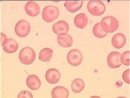 krwotokach zwiększenie) polichromatycznego RDW, Rozmaz krwi: anizocytoza (mikrocyty) hypochromia (anulocyty) poikilocytoza (k.