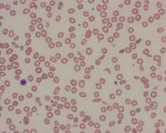 Niedokrwistość hemolityczna skrócenie czasu przeżycia erytrocytów w wyniku nadmiernej hemolizy wewnątrz- lub pozanaczyniowej (w makrofagach układu siateczkowo-śródbłonkowego) przy niedostatecznej