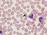 Erytroblasty we krwi polichromatofilia, poikilocytoza Szpik hiperplazja układu czerwonokrwinkowego erytropoeza normoblastyczna Wskaźniki hemolizy spadek stężenia HGB (niedokrwistość normochromiczna)
