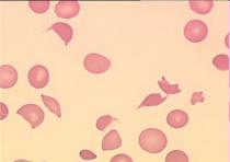 LDH 1 hemosyderyna w moczu urobilinogen w moczu (ciemny) sterkobilinogen w kale Zwiększenie liczby retikulocytów, erytroblasty we krwi obwodowej obraz szpiku: komórkowość podwyższona, stosunek G:E