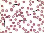 (G6PD) niedobór kinazy pirogronianowej - hemoglobinopatie: defekt hemu: porfiria erytropoetyczna defekt globiny -jakościowy: np.