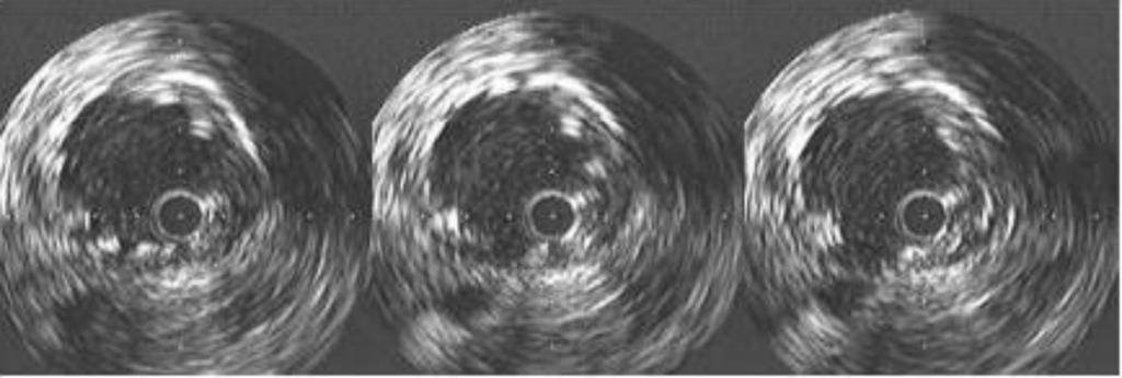 Folia Cardiol. 2003, tom 10, nr 5 A B Rycina 1 A. Obraz ultrasonografii wewnątrznaczyniowej (IVUS) bezpośrednio po zabiegu balonowej angioplastyki i brachyterapii b restenozy w stencie.