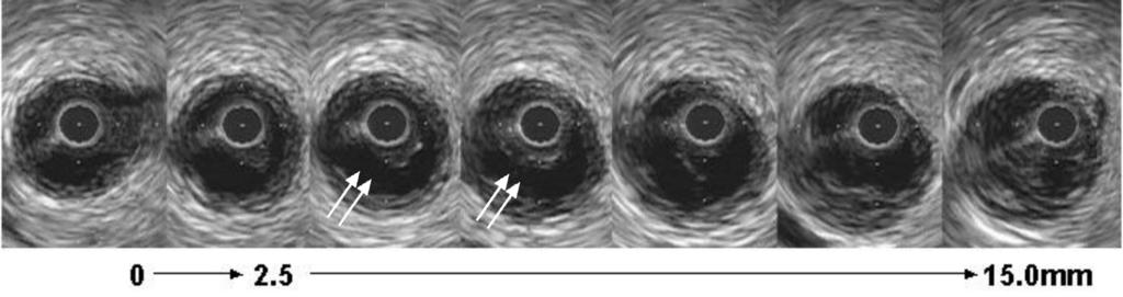 Combined IVUS and angiographic image. Angiographically visible ISR and black necrotic tissue in IVUS. [With kind permission from Dr Gary Mintz] nych dziur.