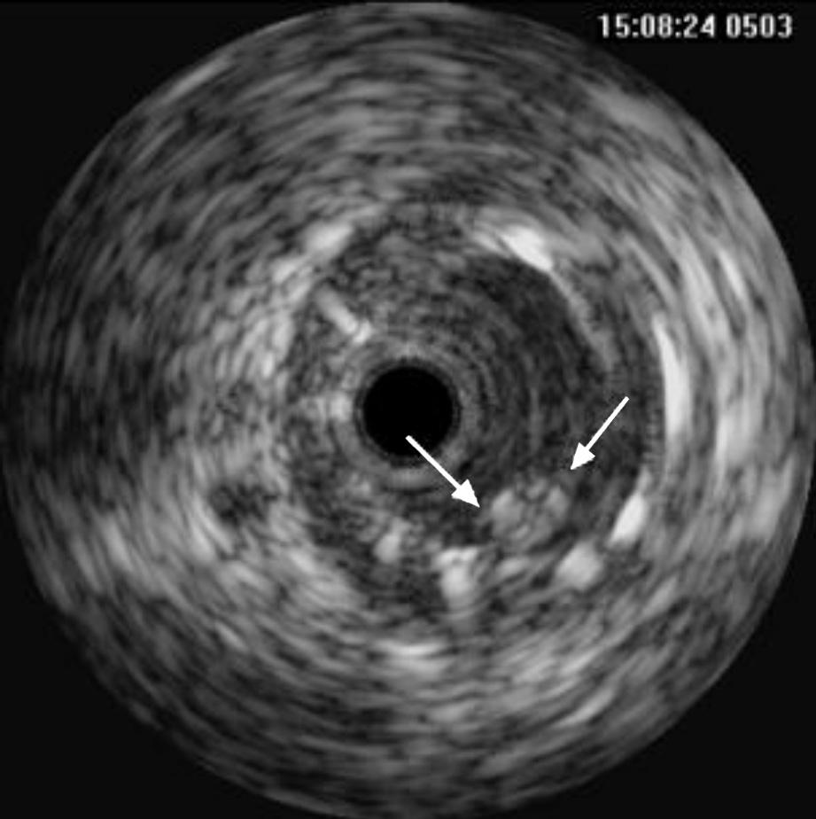 Folia Cardiol. 2003, tom 10, nr 5 Rycina 8. Niewielki kulisty twór odpowiadający przyściennej skrzeplinie w odcinku tętnicy wieńcowej z implantowanym stentem (strzałki) Figure 8.