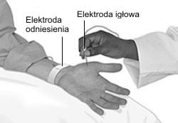 36 Zbigniew Krawiecki, Arkadiusz Hulewicz, Mariusz Cichocki-Kaiser wiające pomiar tego sygnału elektrycznego nazwane zostało elektromiografią [2].