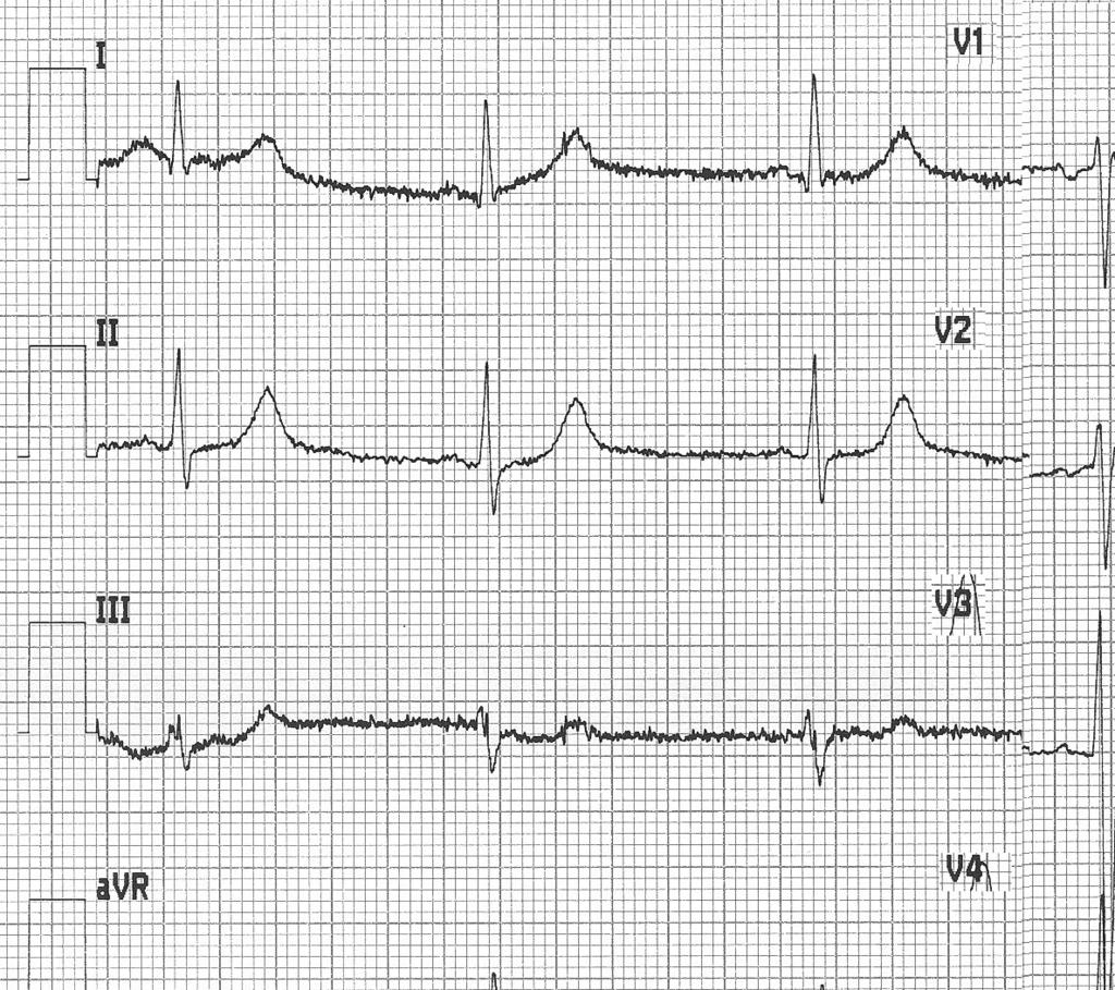 12 M. Ligman i in. Tabela I. Zaburzenia rytmu i przewodzenia w zapisie EKG w grupie badanej (B) i kontrolnej (C) Table I.