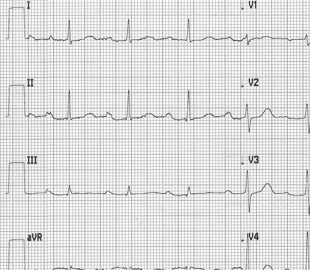 Badanie EKG u młodych sportowców 13 Ryc. 2. Elektrokardiogram młodego sportowca. Blok przedsionkowo-komorowy pierwszego stopnia z odstępem PQ 240 ms.