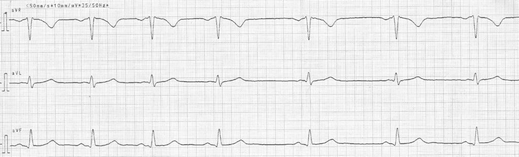 The electrocardiogram from group B Ryc. 3. Elektrokardiogram młodego sportowca. Niemiarowość zatokowa i częściowy blok prawej odnogi pęczka Hisa.