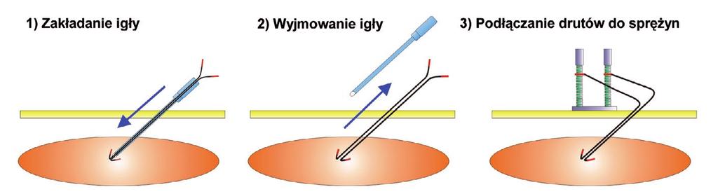 Po usunięciu igły dalsze zakończenia elektrod podłącza się do adapterów wykonanych ze stalowej sprężynki, które następnie podłączane są do złącza przedwzmacniacza EMG.