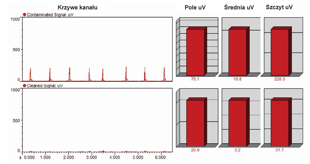 Obróbka sygnału redukcja EKG W jaki sposób usunąć artefakty EKG Jak poprzednio opisano w rozdziale Artefakty EMG, wyładowania EKG mogą zakłócać zapisy EMG z górnej połowy ciała.