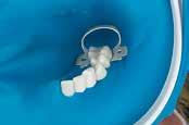 Stosując nitkę dentystyczną przeprowadzić koferdam przez punkty styczne, zaczynając od siekaczy przyśrodkowych.