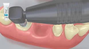 4 Izolacja i oczyszczenie powierzchni preparacji Oczyścić preparację zęba za pomocą szczoteczki do polerowania i pasty do czyszczenia bez
