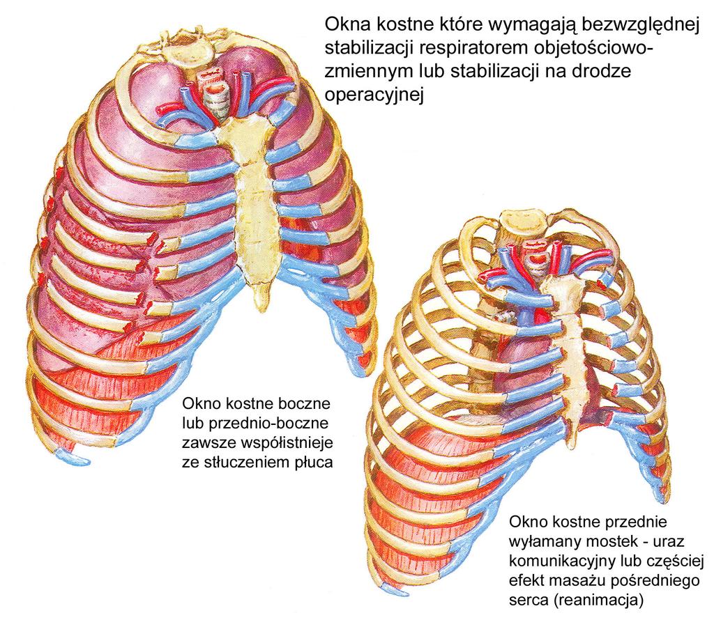 Oddech paradoksalny ( wiotka klatka